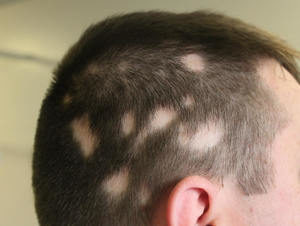 L’alopecia è un problema dei capelli e peli e riguarda la degradazione della loro qualità e la progressiva diradazione o scompars